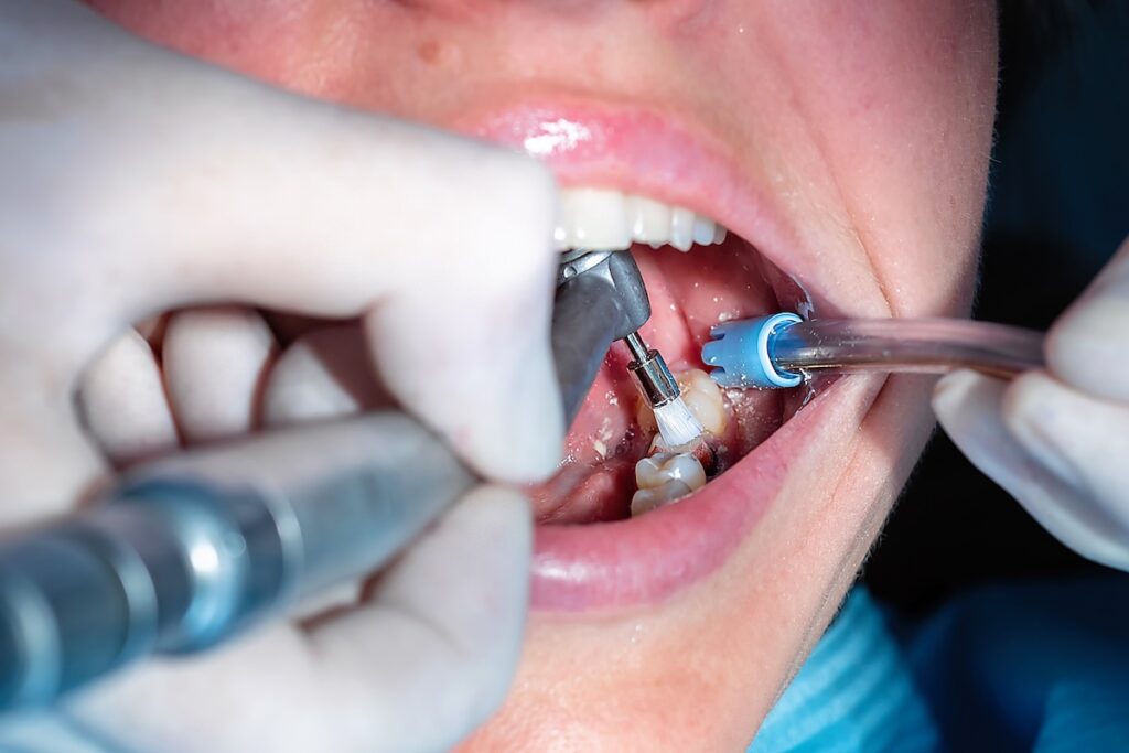 Family Dentist of Stuart | Dental Bonding