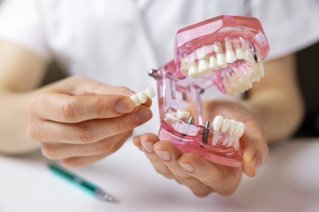 Family Dentist of Stuart | Dental Bridges