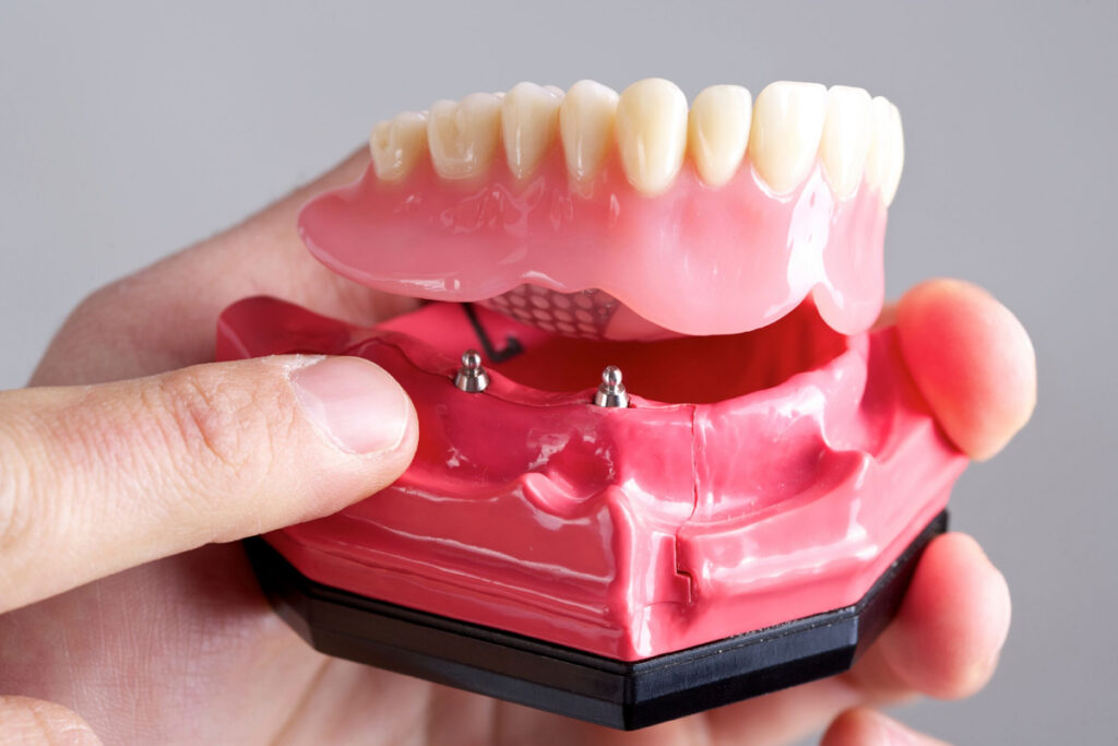Family Dentist of Stuart | Affordable Implants: A Worthy Investment?