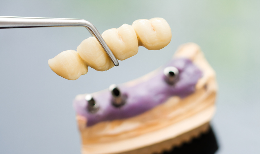 Family Dentist of Stuart | Dental Bridges: Your Pathway to a Perfect Smile Family Dentist of Stuart | Dental Bridges: Your Pathway to a Perfect Smile