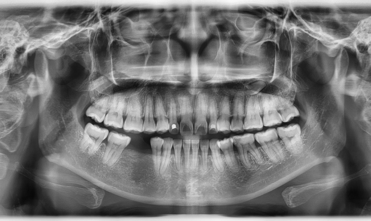 Family Dentist of Stuart | Dental X-Rays: Are They Necessary and How Safe Are They?