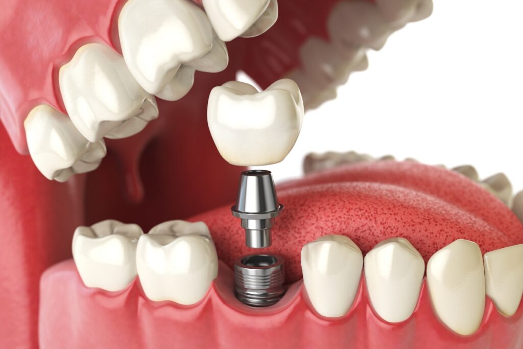 Family Dentist of Stuart | Are You a Candidate? A Comprehensive Guide to Dental Implant Eligibility