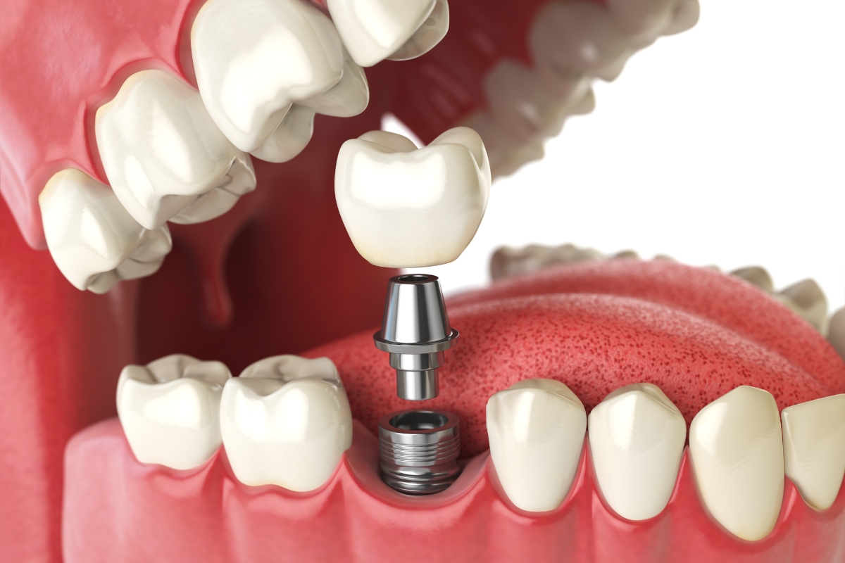 Family Dentist of Stuart | Are You a Candidate? A Comprehensive Guide to Dental Implant Eligibility