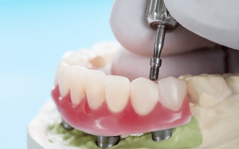 Family Dentist of Stuart | How Dental Implants Can Enhance Your Chewing Ability