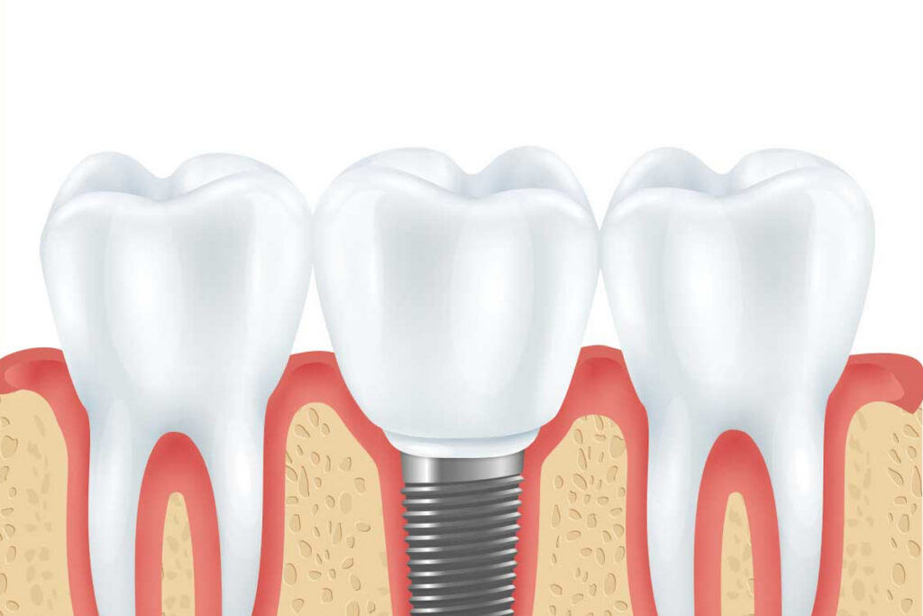 Family Dentist of Stuart | How to Adjust to Dental Implants From Your Dentist in Stuart, Fl