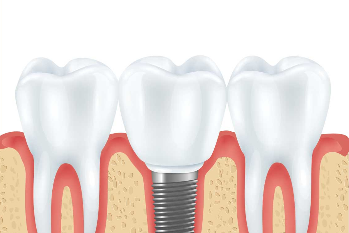 Family Dentist of Stuart | How to Adjust to Dental Implants From Your Dentist in Stuart, Fl