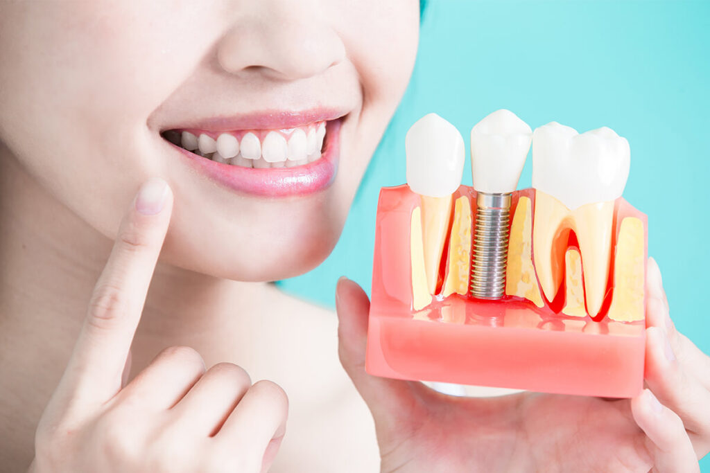 Family Dentist of Stuart | Stuart Fl Affordable Implants: What You Need to Know