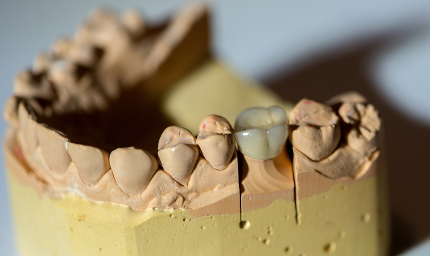 Family Dentist of Stuart | Can a Dentist Repair a Cracked Crown or Loose Bridge? Family Dentist of Stuart | Can a Dentist Repair a Cracked Crown or Loose Bridge?