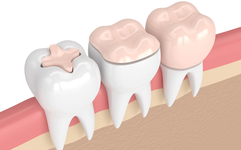 Family Dentist of Stuart | Inlays Vs. Onlays: What’s The Difference And Which Is Right For You?