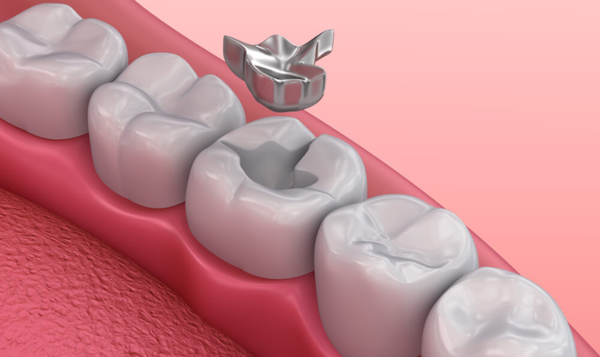 Family Dentist of Stuart | How to Ease Discomfort from a Lost Filling or Crown Before Your Dentist Visit