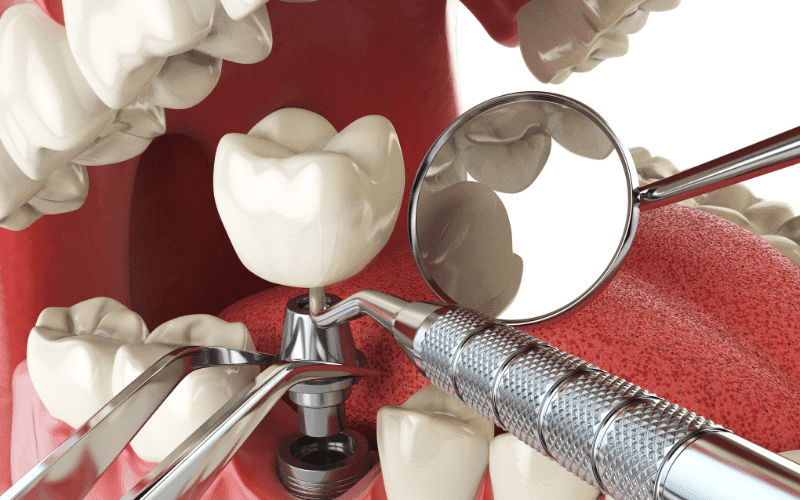 Family Dentist of Stuart | How to Maintain Optimal Oral Hygiene with Dental Implants?