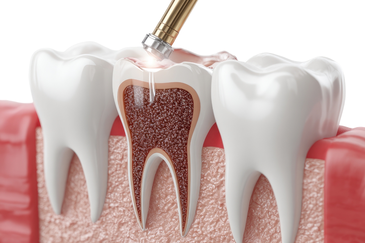 Family Dentist of Stuart | Managing Post-Root Canal Sensitivity: Advice from Dr. Anthony Sconzo