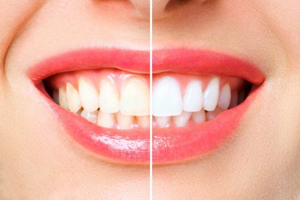 Family Dentist of Stuart | The 60-Minute Smile: A Deep Dive into In-Office Teeth Whitening in Stuart, FL
