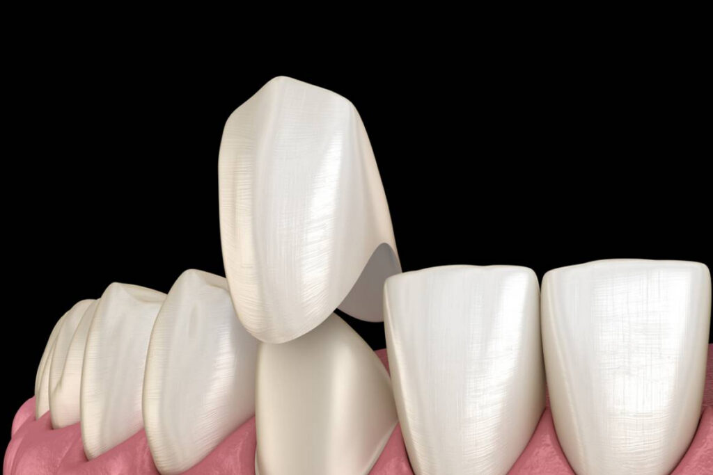 Family Dentist of Stuart | Get a Total Smile Makeover With Veneers