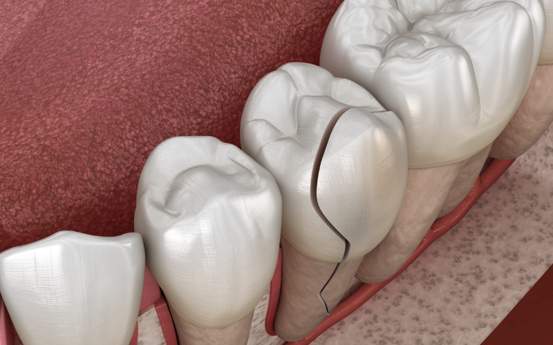 Family Dentist of Stuart | Cracked Or Broken Crown? Here’s What To Do Next