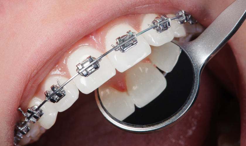 Family Dentist of Stuart | Teeth and Invisalign Hygiene After Eating: Expert Cleaning Tips