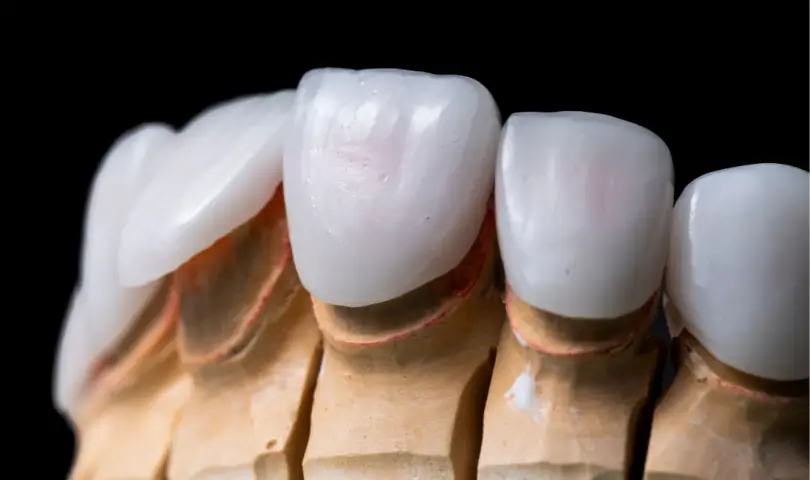 Family Dentist of Stuart | What Are The Key Components Of Dental Veneers? Materials Explained Family Dentist of Stuart | What Are The Key Components Of Dental Veneers? Materials Explained