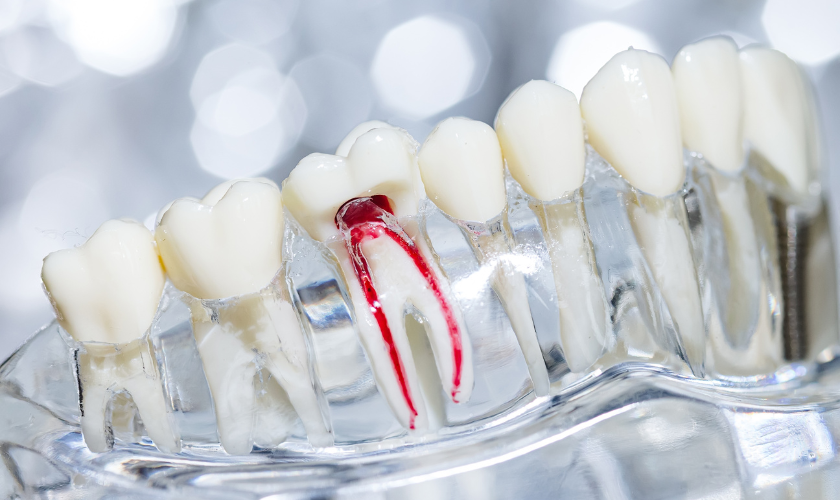 Family Dentist of Stuart | The Role of Nutrition in Healing After A Root Canal Therapy