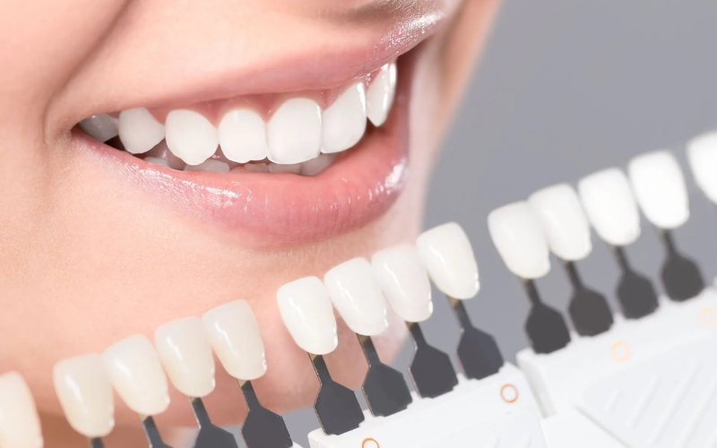 Family Dentist of Stuart | Are Your Veneers Still Doing Their Job Or Is It Time For A Change?