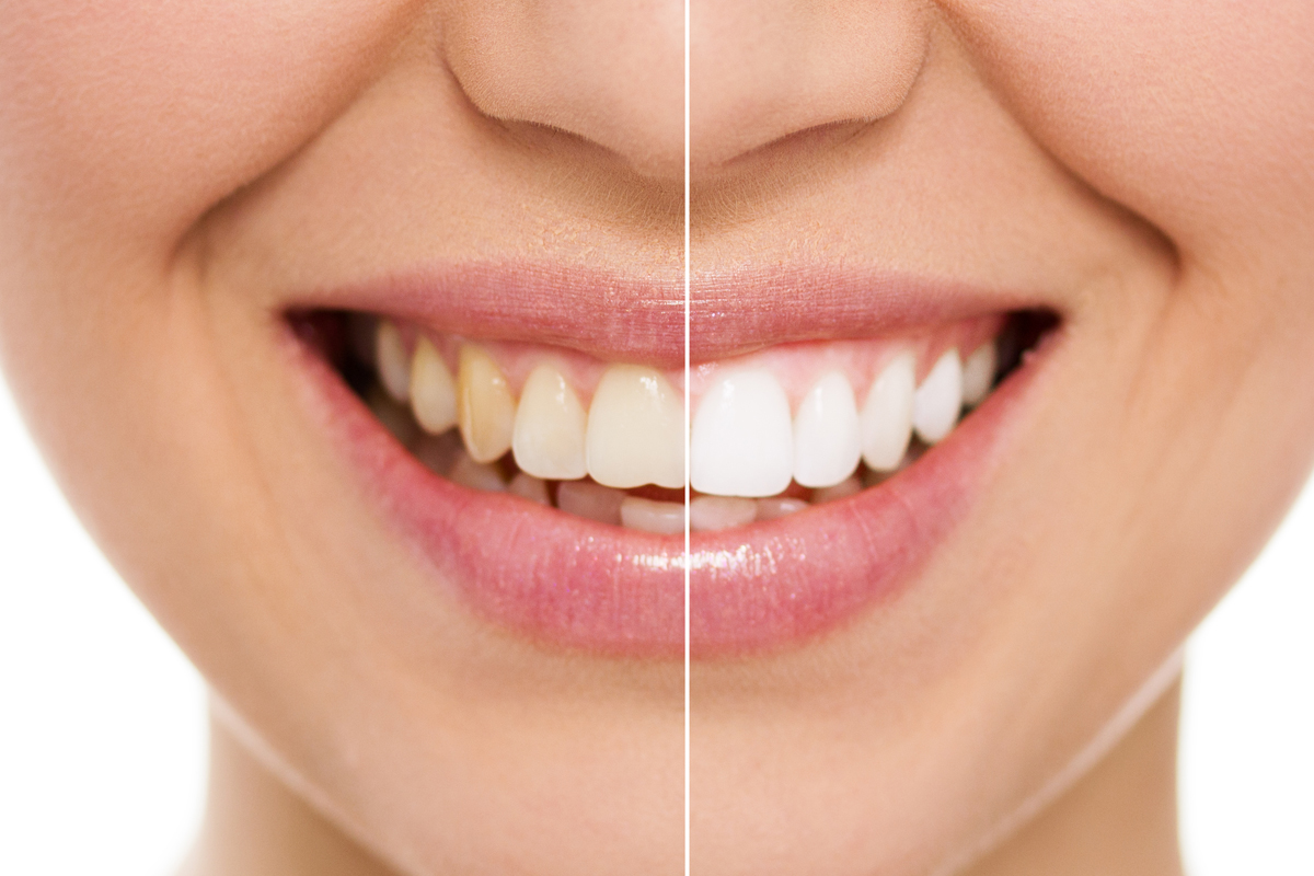 Family Dentist of Stuart | Transform Your Smile With Teeth Whitening