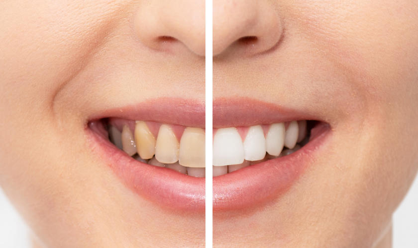 Family Dentist of Stuart | Unveiling the Myths and Magic Behind Teeth Whitening