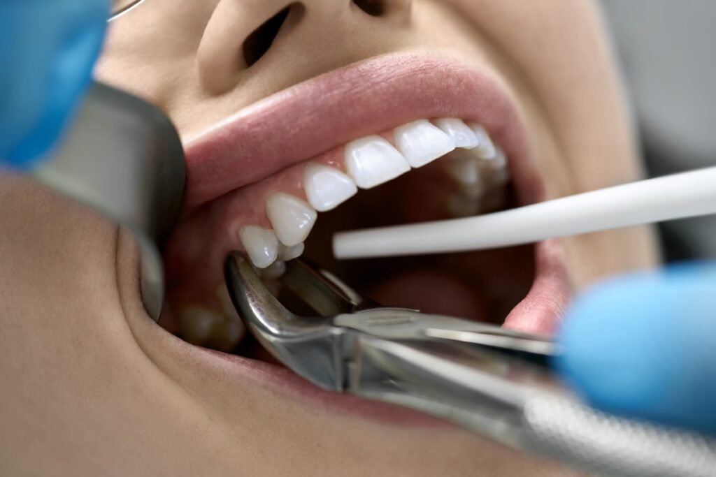 Family Dentist of Stuart | Tooth Extractions