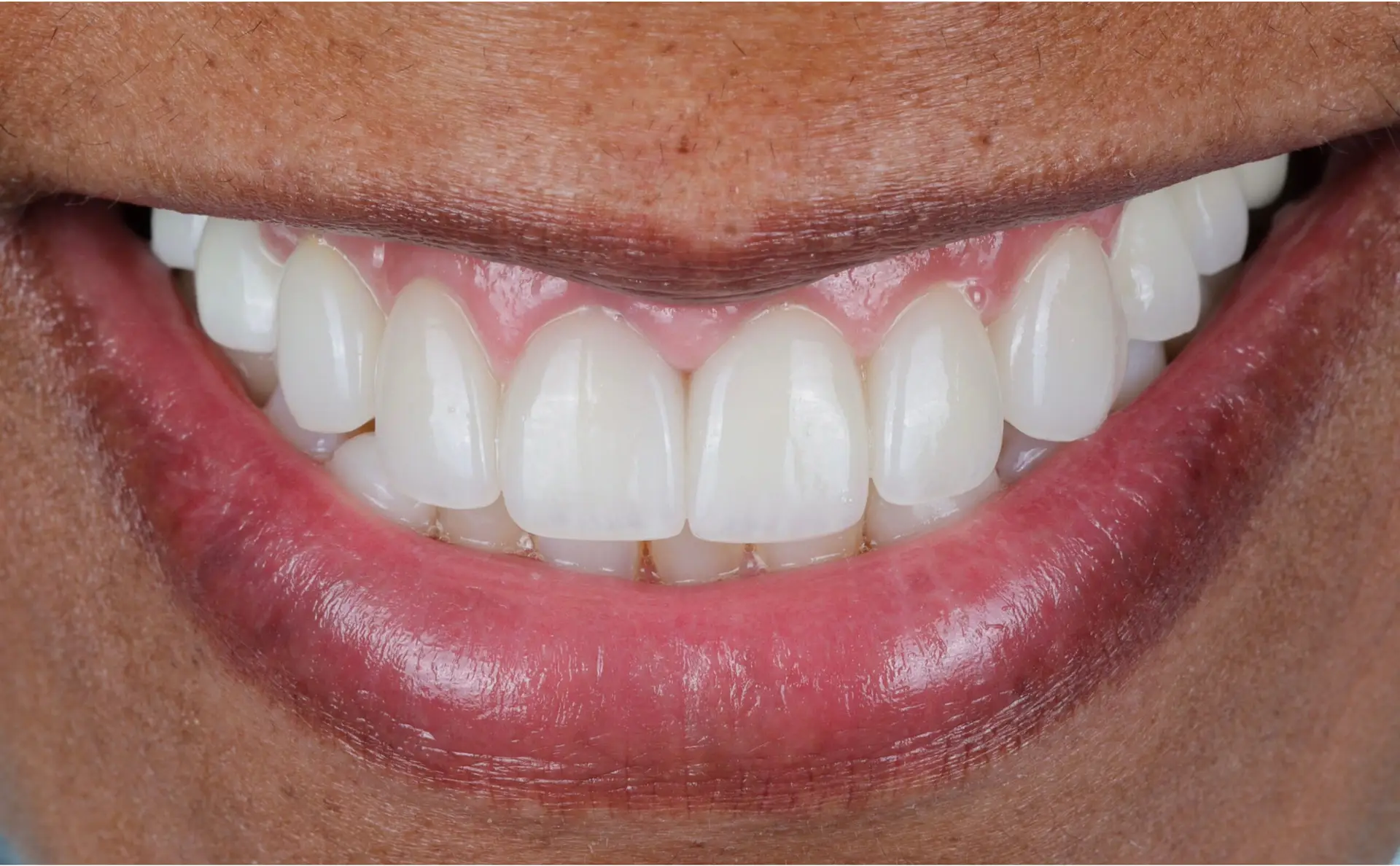 Family Dentist of Stuart | Smile Gallery