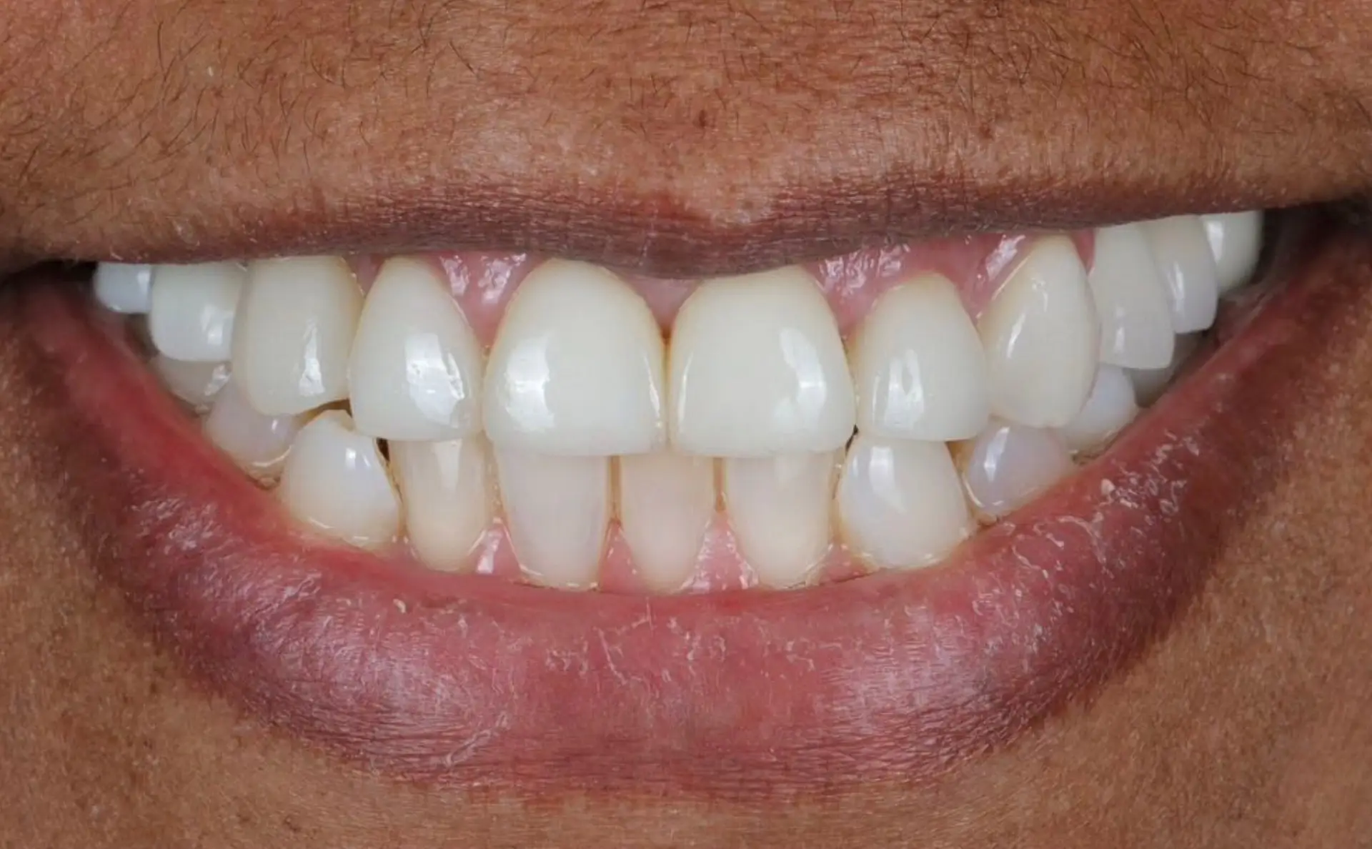 Family Dentist of Stuart | Smile Gallery