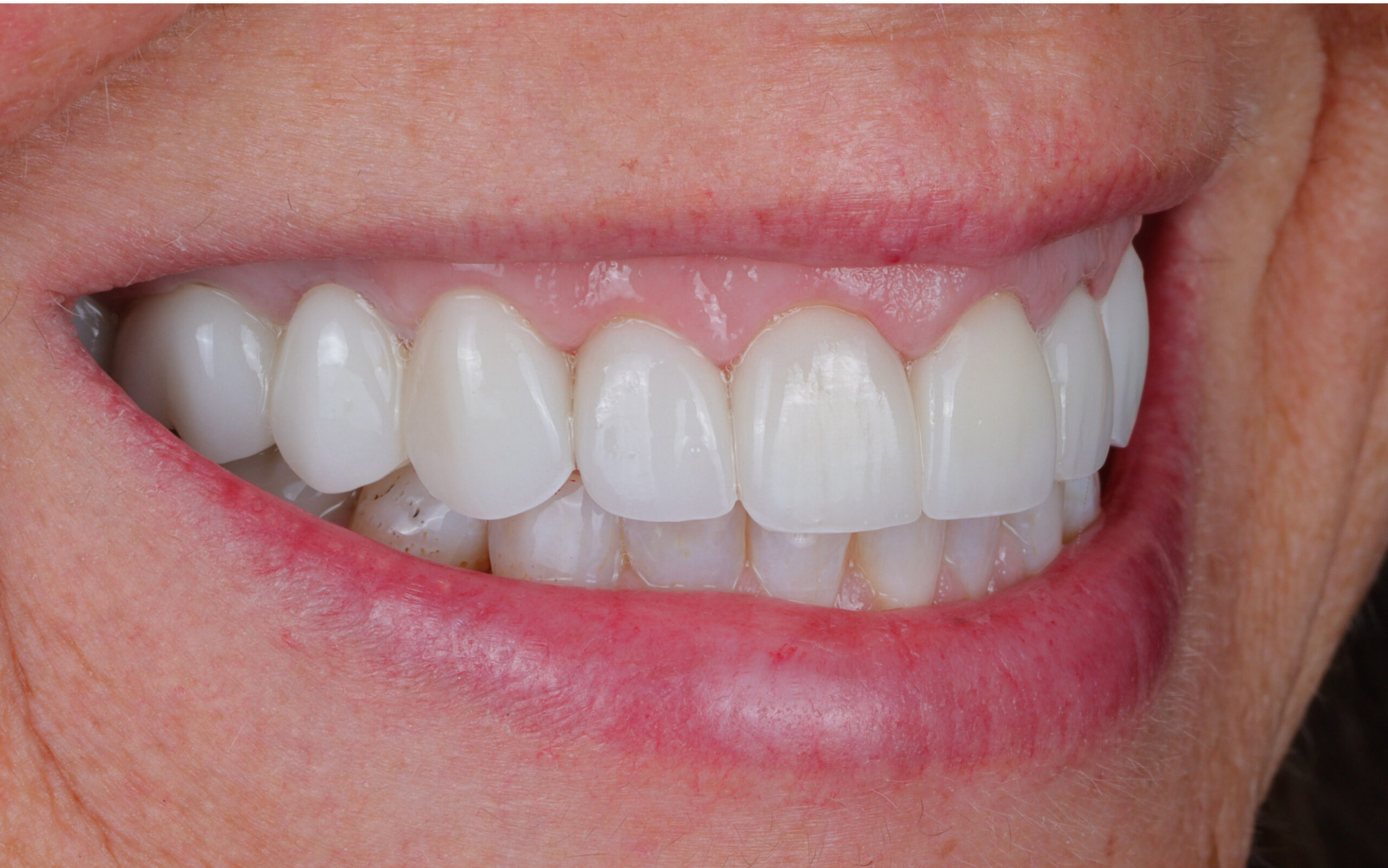 Family Dentist of Stuart | Smile Gallery