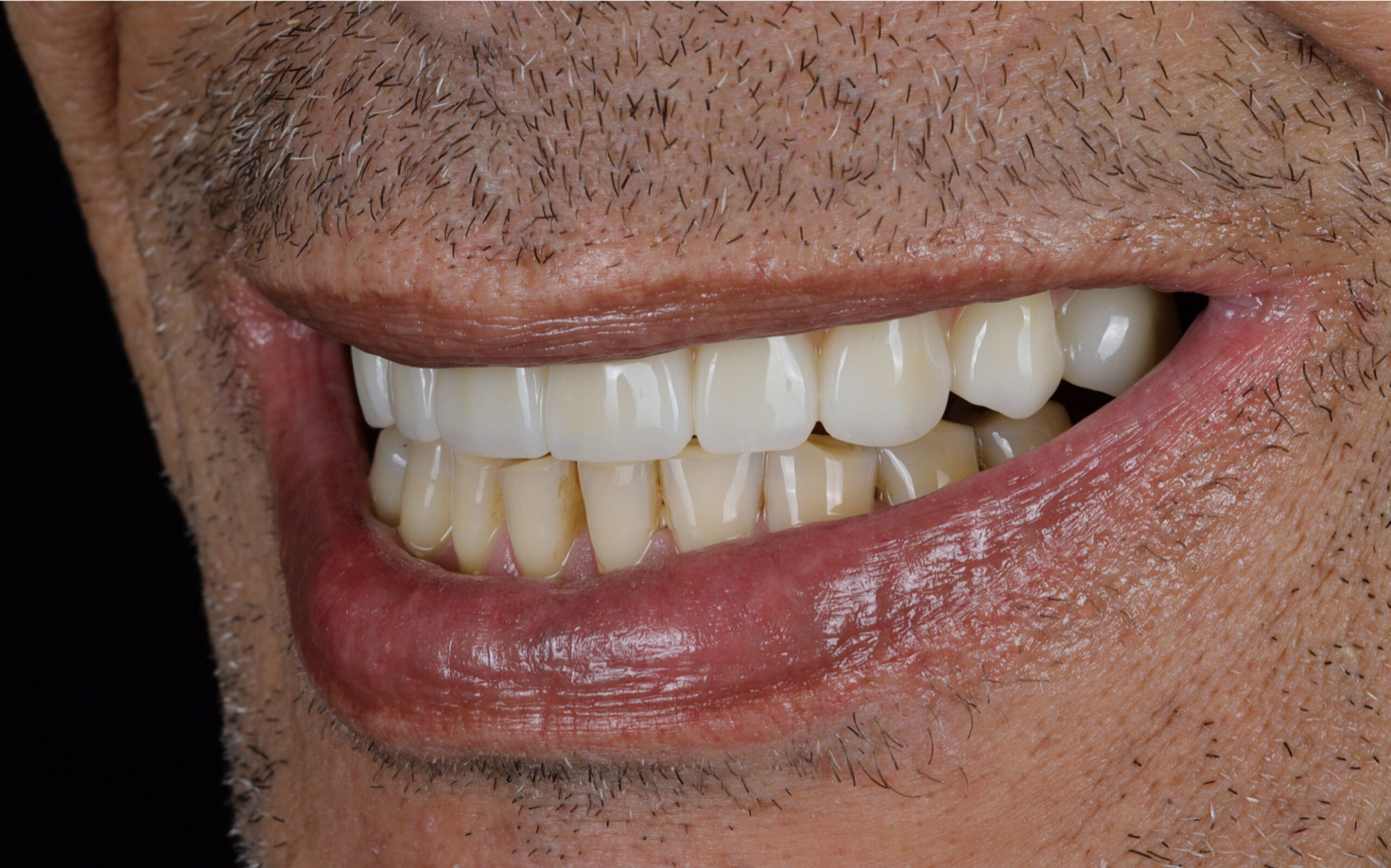 Family Dentist of Stuart | Smile Gallery