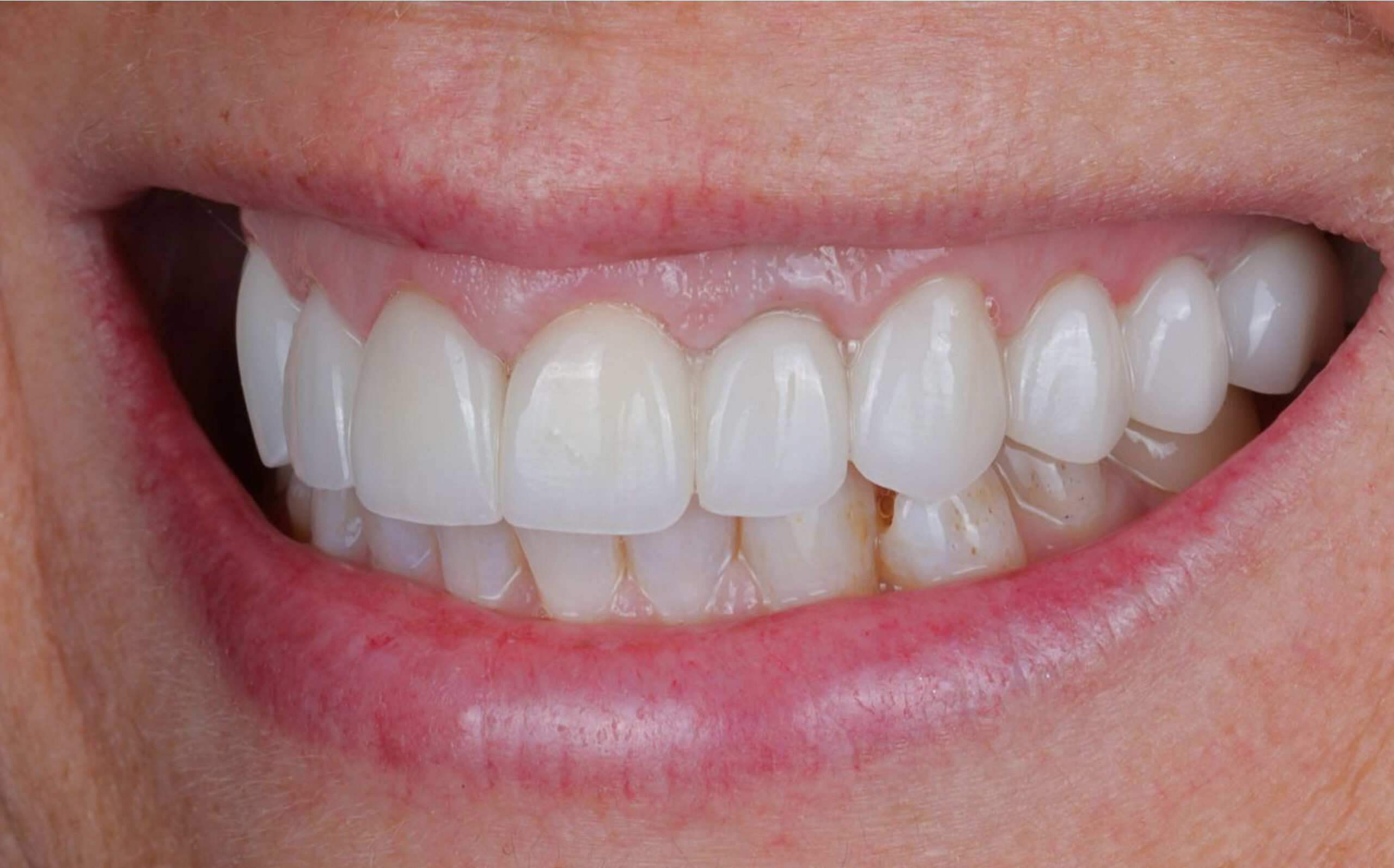 Family Dentist of Stuart | Smile Gallery