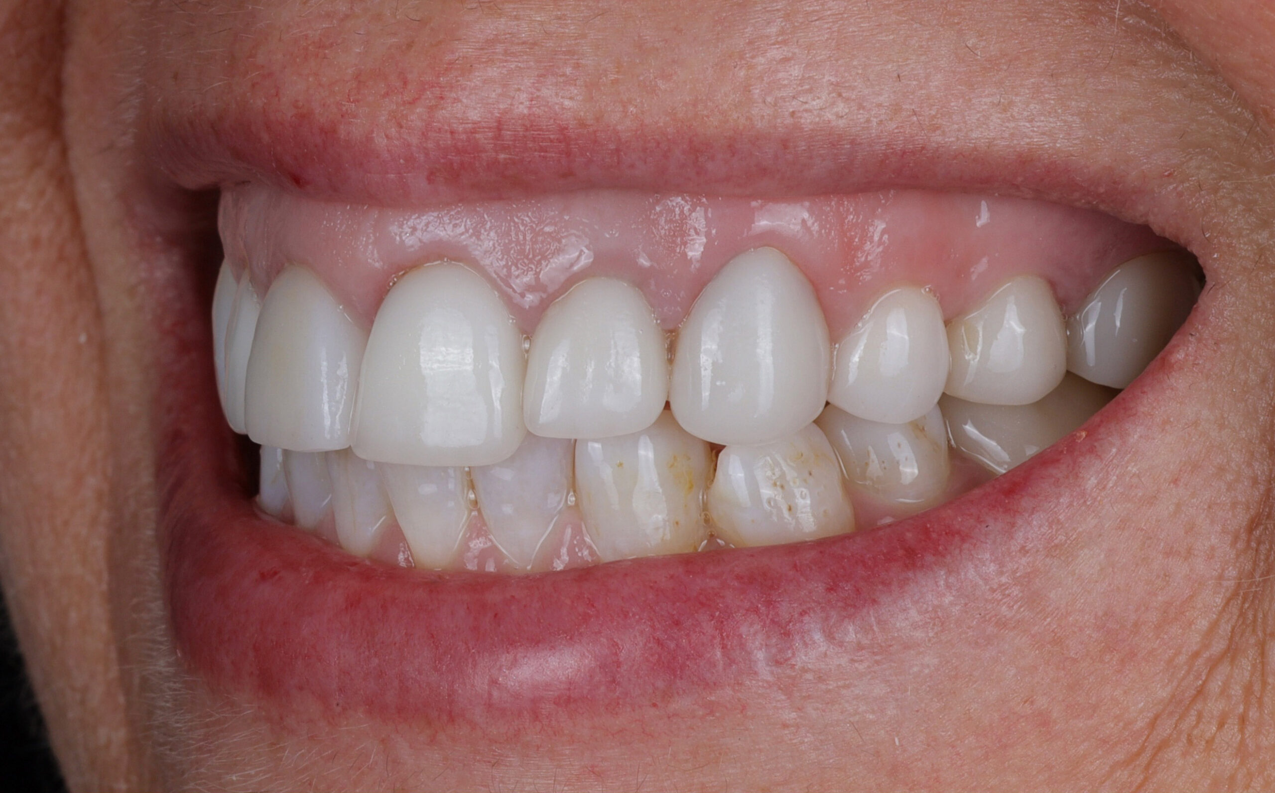 Family Dentist of Stuart | Smile Gallery