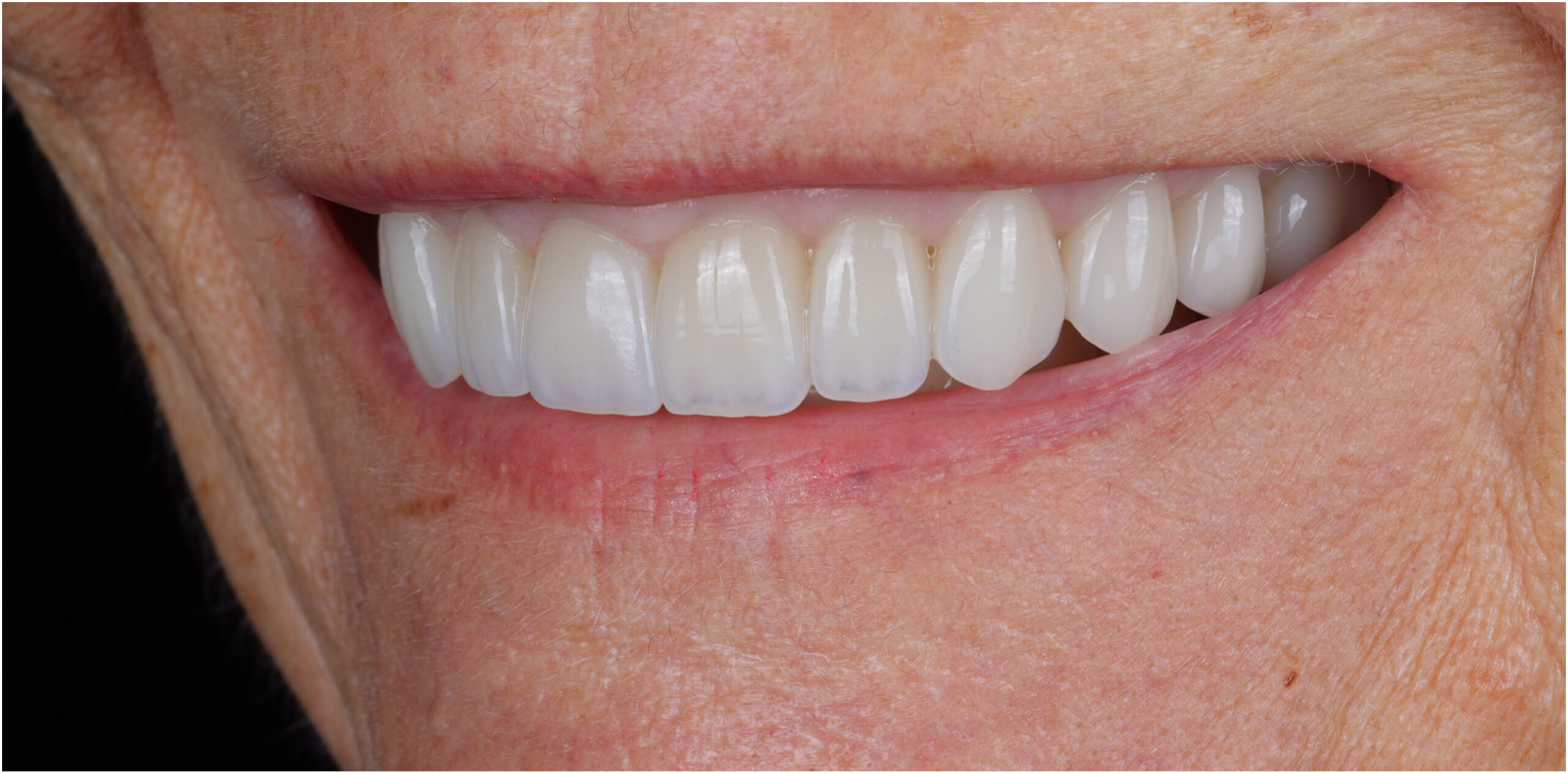 Family Dentist of Stuart | Smile Gallery