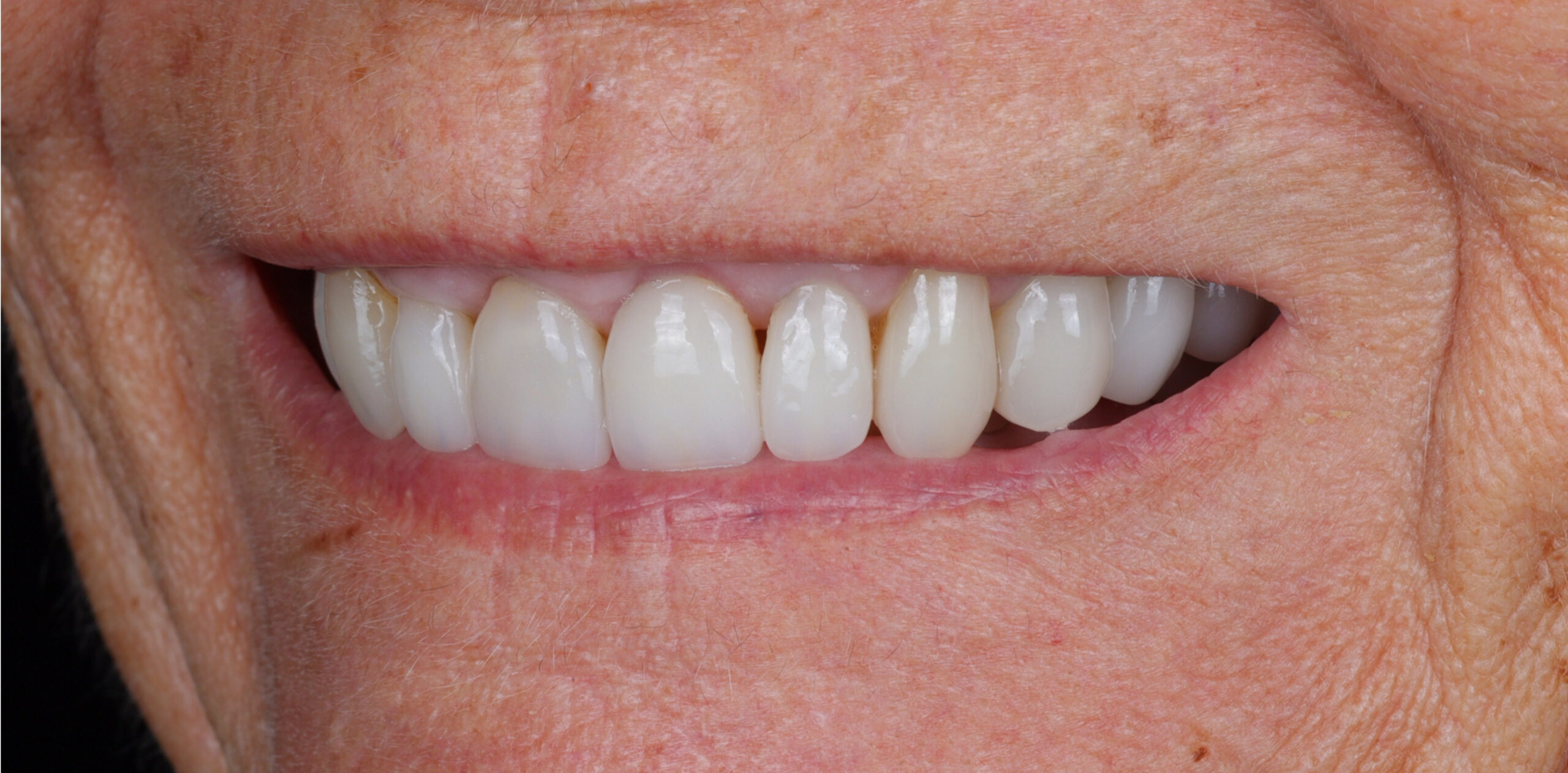 Family Dentist of Stuart | Smile Gallery