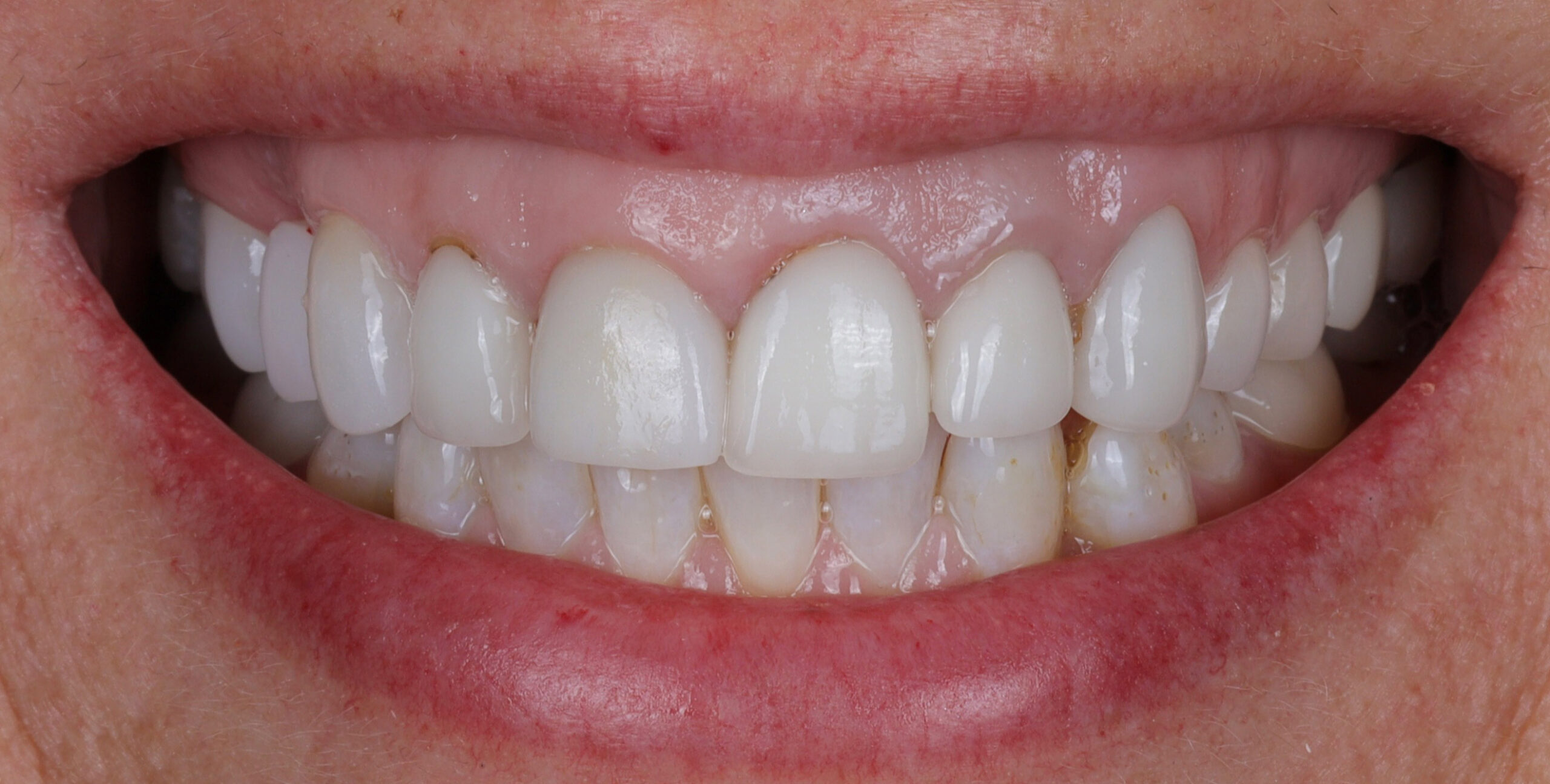 Family Dentist of Stuart | Smile Gallery