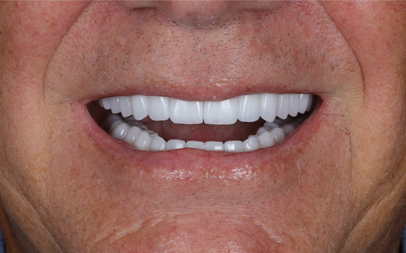 Family Dentist of Stuart | Smile Gallery