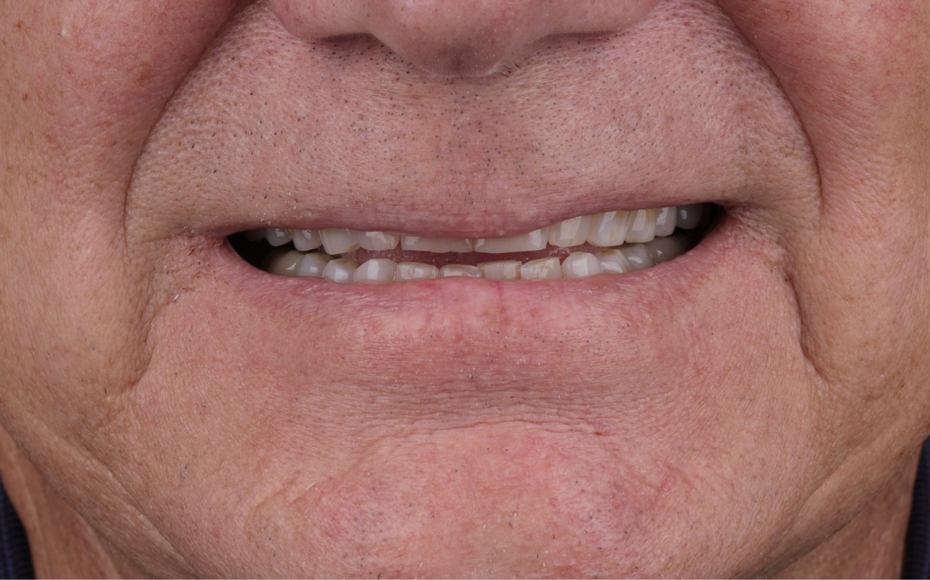 Family Dentist of Stuart | Smile Gallery