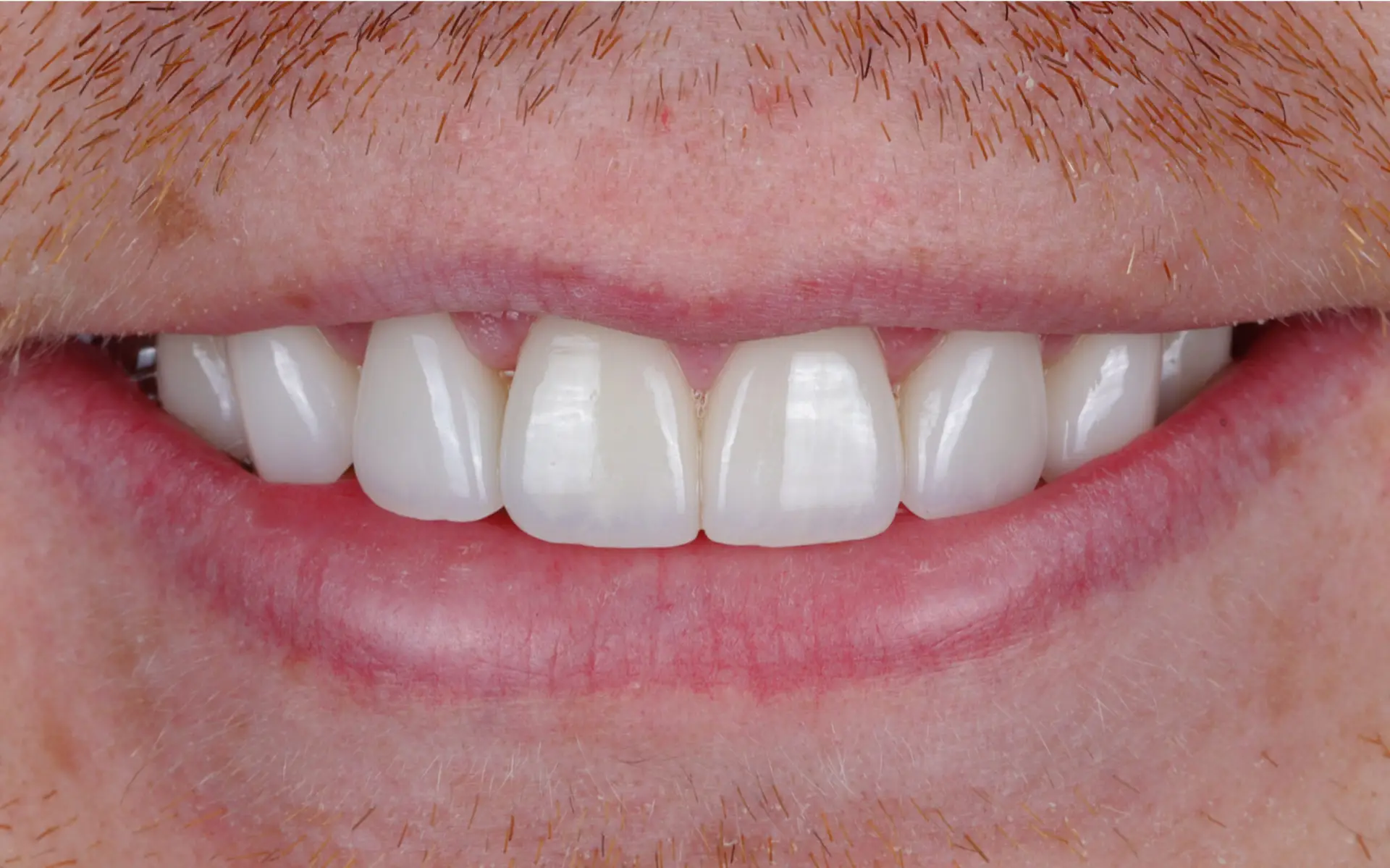 Family Dentist of Stuart | Smile Gallery