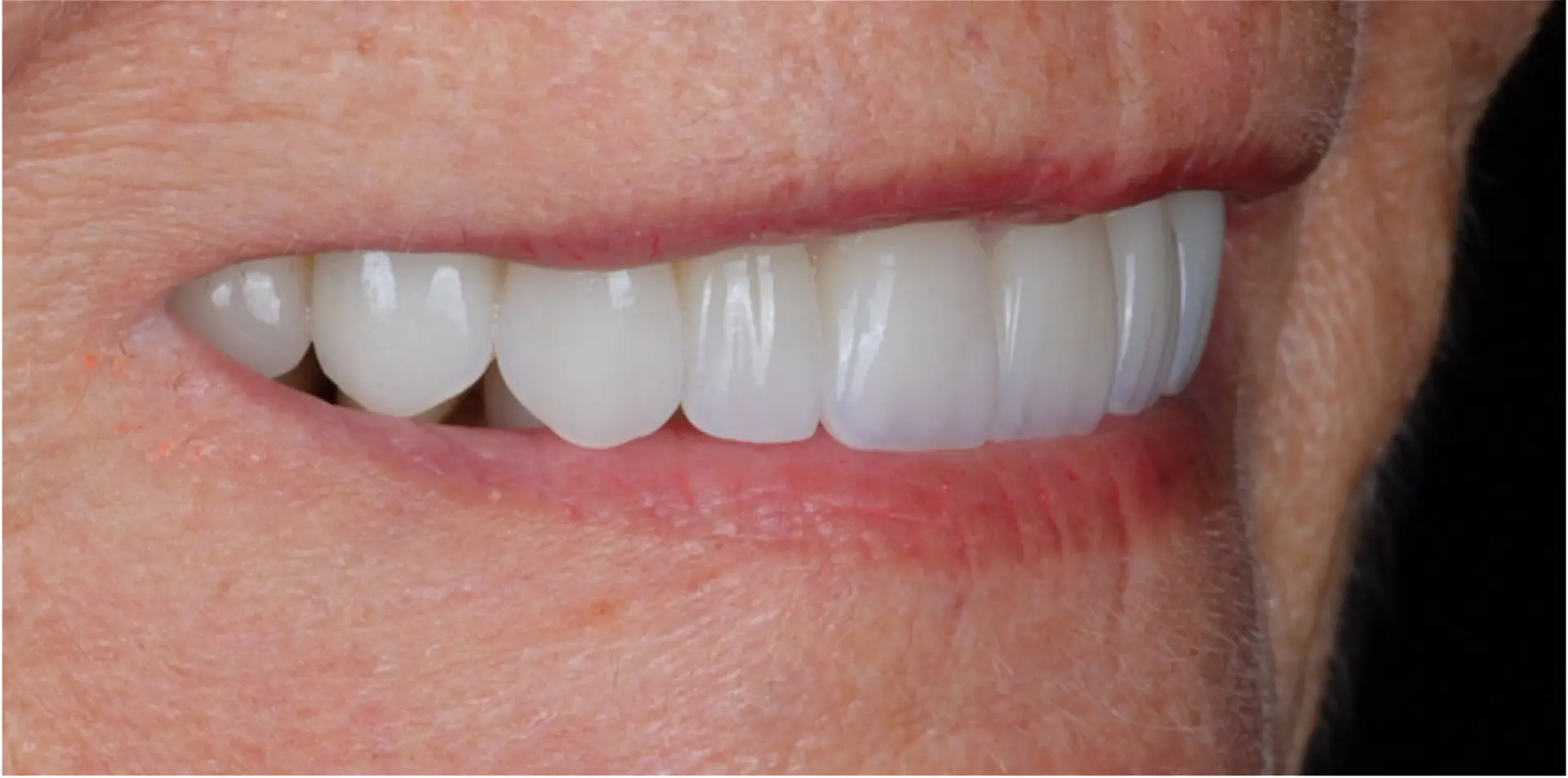 Family Dentist of Stuart | Smile Gallery