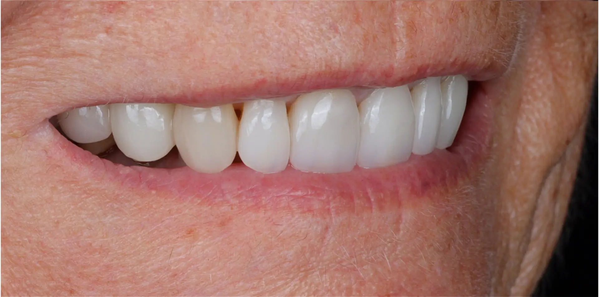 Family Dentist of Stuart | Smile Gallery