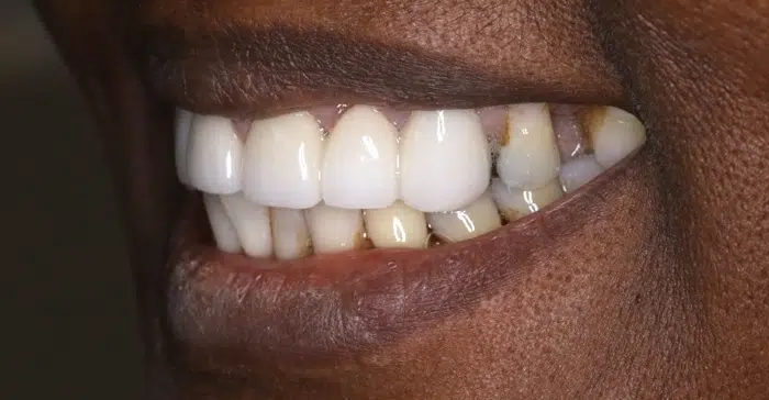 Family Dentist of Stuart | Smile Gallery