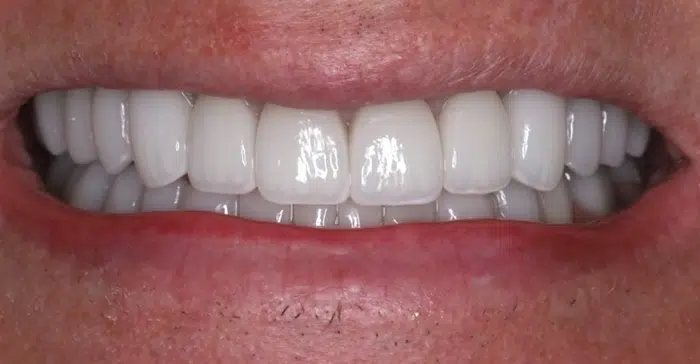 Family Dentist of Stuart | Smile Gallery