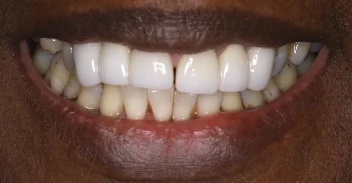 Family Dentist of Stuart | Smile Gallery