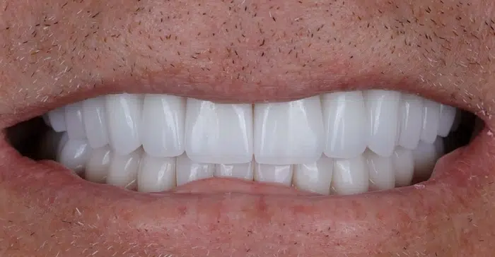 Family Dentist of Stuart | Smile Gallery