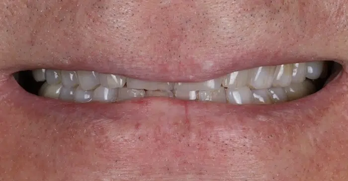 Family Dentist of Stuart | Smile Gallery