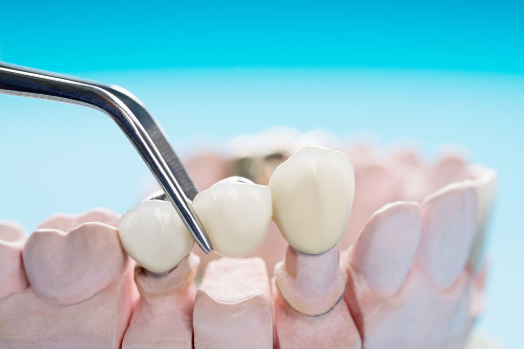 Dental Bridges in Stuart, FL: Filling Smile Gaps with Strength and Confidence