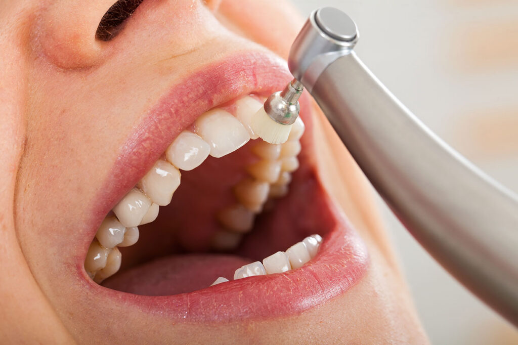 Dental Cleanings in Stuart, FL: Why Prevention Keeps Your Smile Strong